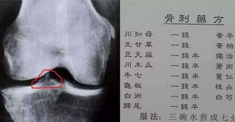 【 骨刺的藥方 】大公開！只喝了4天，就沒有痛了！ 沒找醫生開刀！