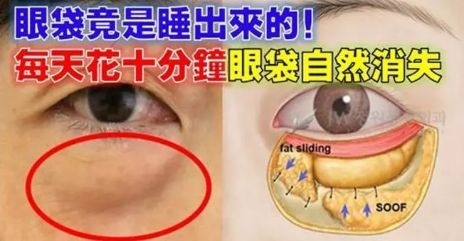 「眼袋」竟是睡出來的!每天只要花10分鐘這樣做,顯老眼袋自然消!