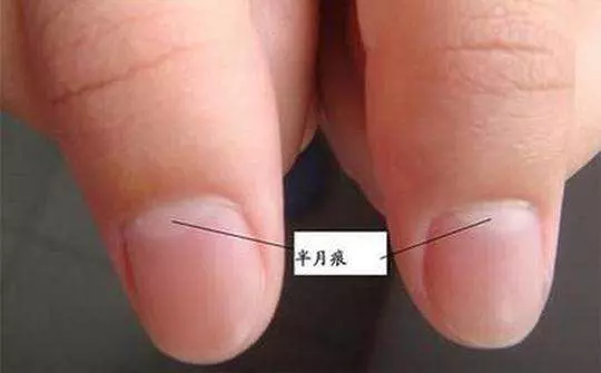 老中醫說: 通過看指甲你就會知道, 可能是患上了糖尿病, 看過都說准!