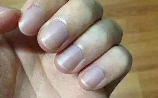 老中醫說: 通過看指甲你就會知道, 可能是患上了糖尿病, 看過都說准!