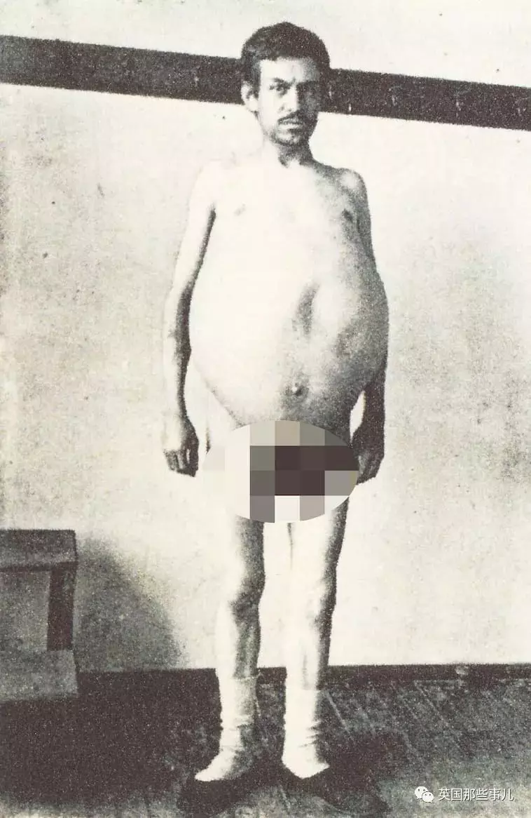 他是「全世界擁有最大啤酒肚」的男性,在他離世後,醫生剖腹竟發現原來他肚子裡裝的都是「這些」!