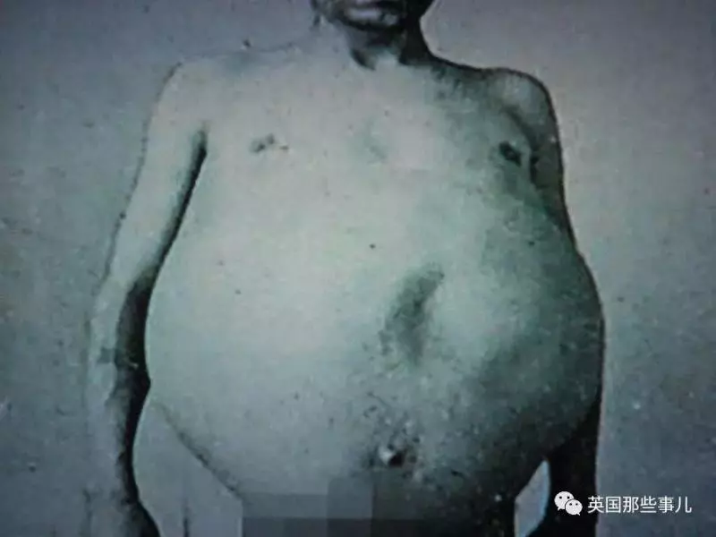 他是「全世界擁有最大啤酒肚」的男性,在他離世後,醫生剖腹竟發現原來他肚子裡裝的都是「這些」!