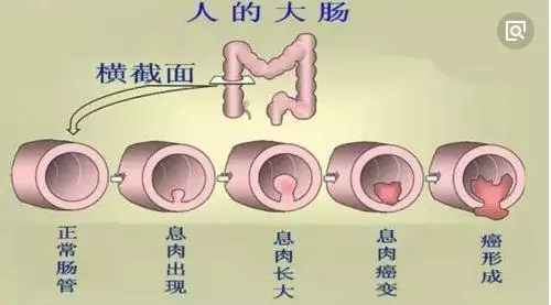 胃腸道「息肉」是什麼?醫生:息肉是癌的近親,要引起注意