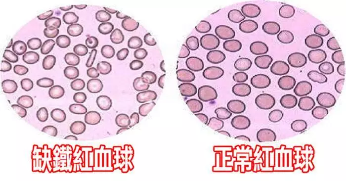他一入夜就感覺雙腿有「螞蟻在爬蟲子在咬」無法安穩入睡,誰也沒想到這竟是「帕金森」的前兆!