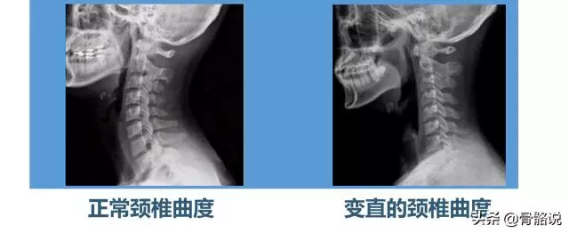 頸椎病5個鍛煉動作詳解,超簡單!每次3分鐘,拯救生命線