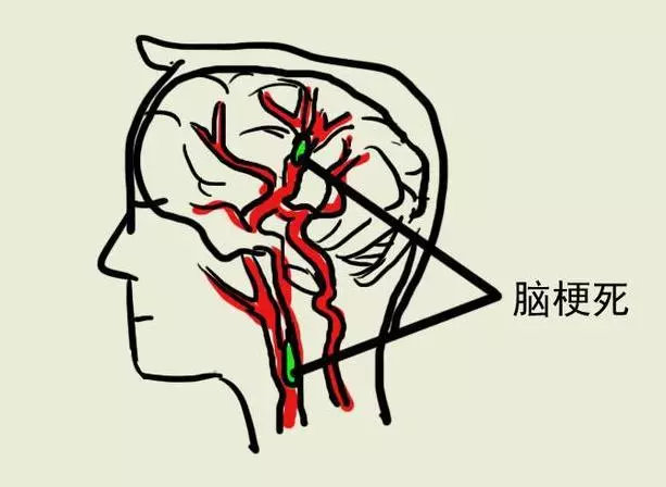 醫生提醒:睡覺時有這種表現就是中風前兆!一定要警惕