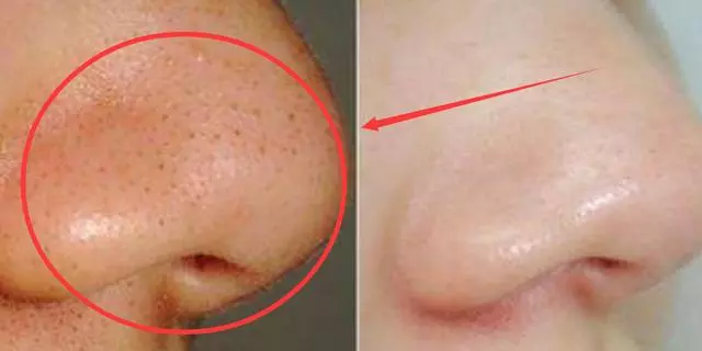 原來廚房藏著祛黑頭的小妙招,這8種東西天天見,很便宜,一搓一抹黑頭見到怕怕怕