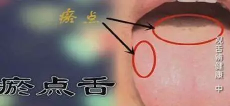 從舌頭一眼看是否癌症體質,癌細胞最怕1種鹼性食物,常吃防癌
