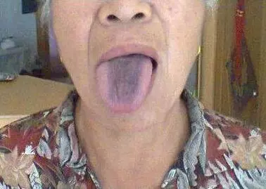從舌頭一眼看是否癌症體質,癌細胞最怕1種鹼性食物,常吃防癌