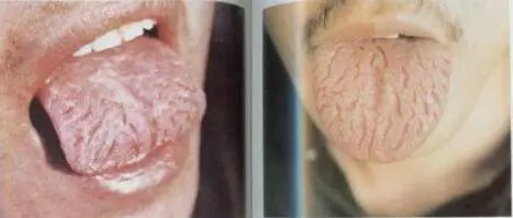 從舌頭一眼看是否癌症體質,癌細胞最怕1種鹼性食物,常吃防癌