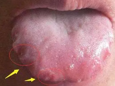從舌頭一眼看是否癌症體質,癌細胞最怕1種鹼性食物,常吃防癌