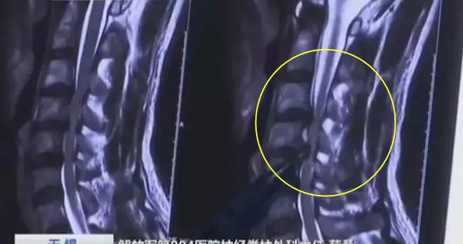 致命壞習慣⚡!每天躺沙發上玩手機,男子突然呼吸困難,39歲就『脊髓偏癱瘓』!?