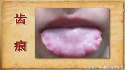 齒痕舌,我一定要戰勝你