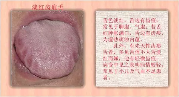 齒痕舌,我一定要戰勝你