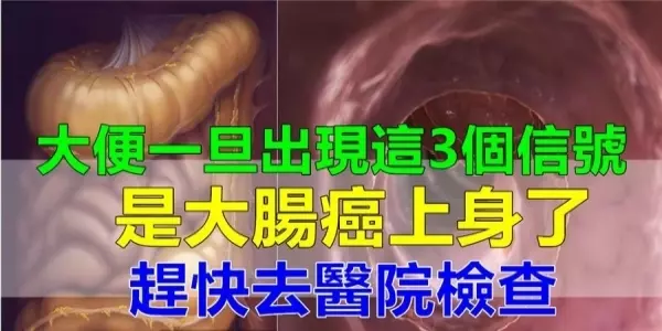 腫瘤專家警告:大便出現3個訊號,是大腸癌!