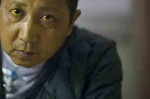 肝病多是「拖」出來的,晨起臉上3種情況,及時檢查,或許能保命