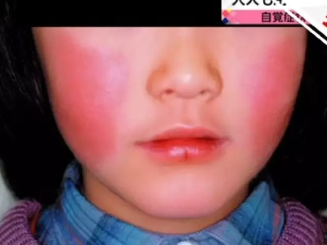 近期內去日本的朋友注意了,尤其是孕婦和兒童!