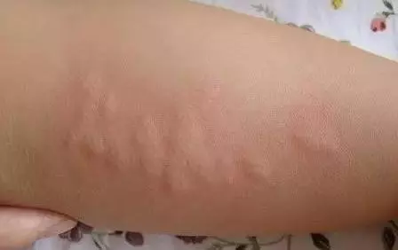 濕疹沒有人不害怕?緩解皮膚瘙癢,少有人知道的3個小妙招!
