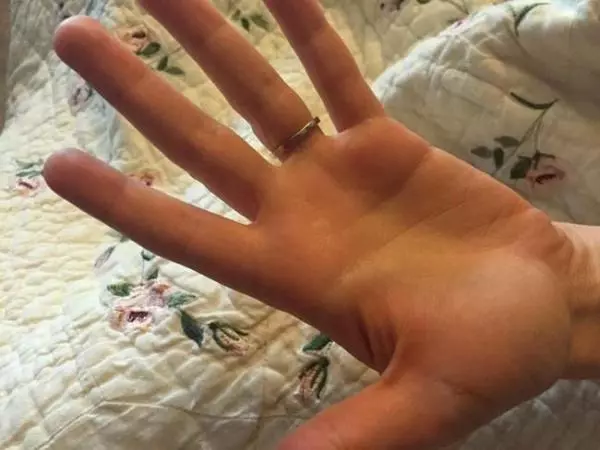 妻子手上出現神秘的小黑點不斷在長大,黑點竟然開始延伸到手背上...醫生告訴她『一句話』當場差點嚇暈!