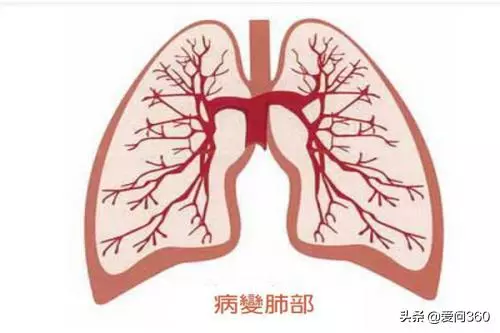 肺不好這4個穴位少不了,堅持按摩這幾個穴位,對肺炎也有好處
