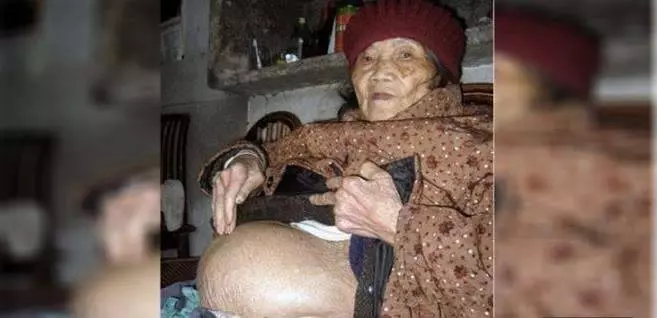 90歲阿嬤肚子竟然隱藏著「這東西」長達58年,醫生看過X光後竟被嚇出一身冷汗!