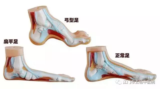走路腳跟疼,像踩到釘子一樣?這病惹禍,簡單四招幫你遠離疼痛