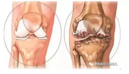 造成膝蓋疼痛的幾種常見原因,我們應如何避免?