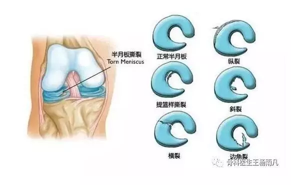 造成膝蓋疼痛的幾種常見原因,我們應如何避免?