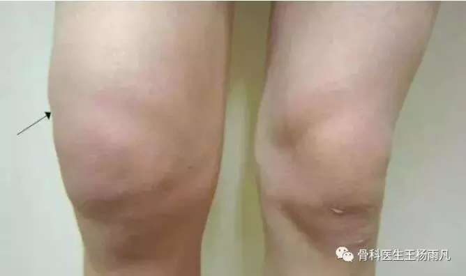 造成膝蓋疼痛的幾種常見原因,我們應如何避免?