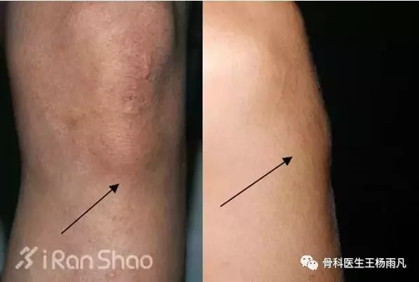 造成膝蓋疼痛的幾種常見原因,我們應如何避免?