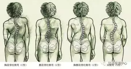 脊柱側彎的治療手法及操作要領
