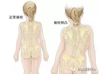 脊柱側彎的治療手法及操作要領