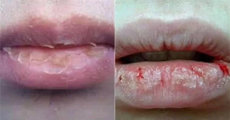 原來你嘴唇老是乾裂,不是因為缺水,而是缺某種維生素