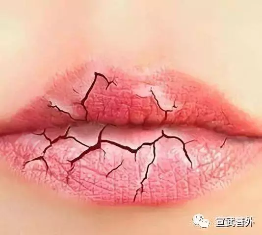 原來你嘴唇老是乾裂,不是因為缺水,而是缺某種維生素