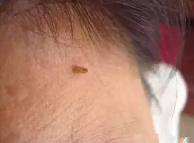 注意了!「脖子長小肉粒」是怎麼回事?他們在警示你,你的身體已出問題!