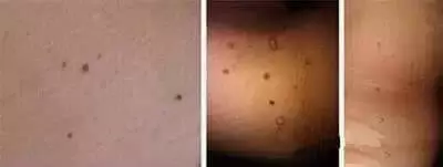注意了!「脖子長小肉粒」是怎麼回事?他們在警示你,你的身體已出問題!
