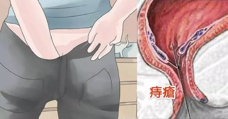 教你兩種方法自然根除「痔瘡」,人人都不再癢只要簡單幾分鐘