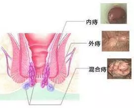 教你兩種方法自然根除「痔瘡」,人人都不再癢只要簡單幾分鐘