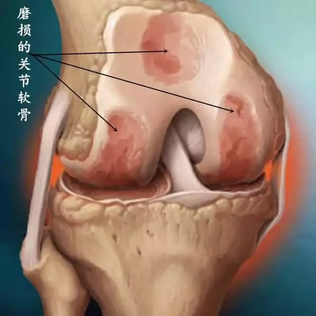 膝蓋疼痛難忍?59歲阿麼用了7天,緩解了膝蓋疼痛,膽固醇和高血壓也降了很多,為爸媽收好!