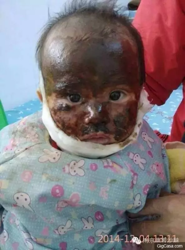 1歲小孩的臉被燙傷,一種「神奇的植物果實」救了孩子!知道了一定要分享!