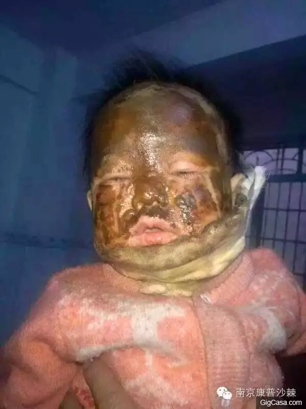 1歲小孩的臉被燙傷,一種「神奇的植物果實」救了孩子!知道了一定要分享!