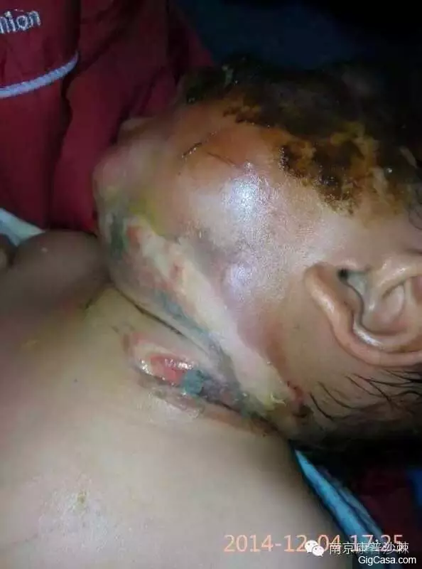 1歲小孩的臉被燙傷,一種「神奇的植物果實」救了孩子!知道了一定要分享!