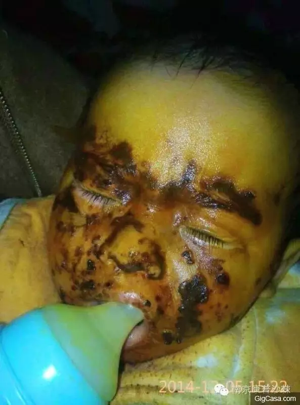 1歲小孩的臉被燙傷,一種「神奇的植物果實」救了孩子!知道了一定要分享!