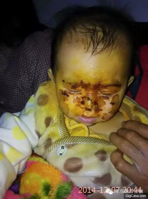 1歲小孩的臉被燙傷,一種「神奇的植物果實」救了孩子!知道了一定要分享!