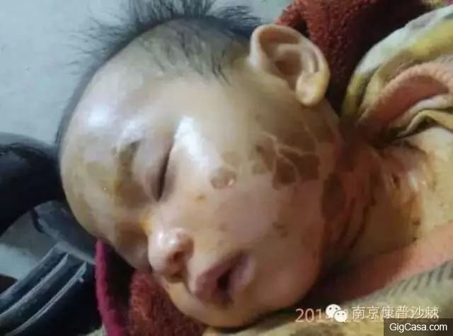 1歲小孩的臉被燙傷,一種「神奇的植物果實」救了孩子!知道了一定要分享!