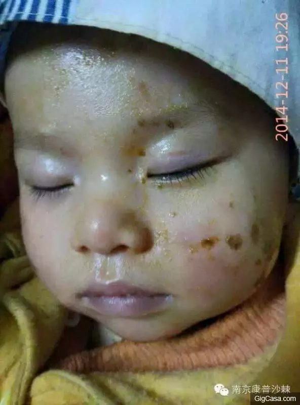 1歲小孩的臉被燙傷,一種「神奇的植物果實」救了孩子!知道了一定要分享!