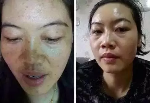 半根黃瓜祛斑法,36歲大姐5天淡斑,一周蛻變水潤豆腐肌!