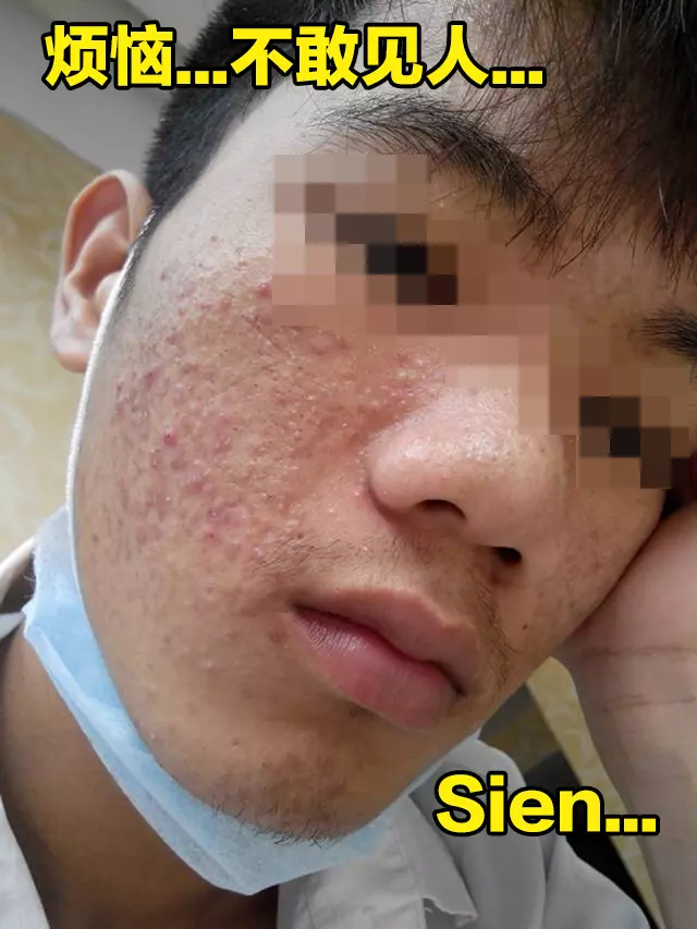 「痘」花臉醫治5步驟!還在為臉上的痘痘感到困擾?這5個步驟保證你變化為男神、女神!