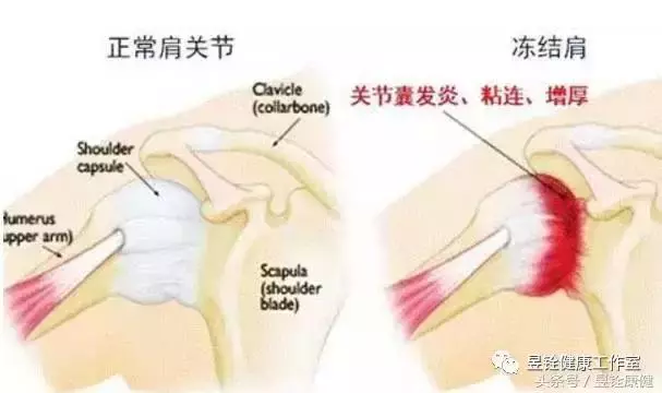 原來!「肩周炎」是這樣引起的....多注意這些就能「緩解症狀」!