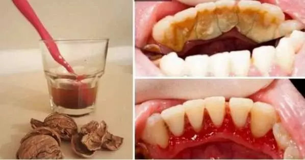 「牙結石」「口臭」難消除?教你一個簡單天然辦法,不用看醫生,牙結石嘩嘩往下掉哦!